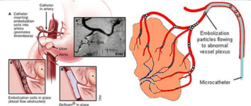 Aneurysm Treatment